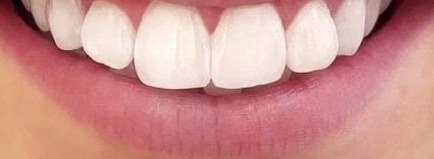 Dents après 5 jours de kit OnlySmile, cliente 2