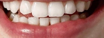 Dents après 5 jours de kit OnlySmile, cliente 3