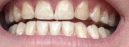 Dents après 5 jours de kit OnlySmile, cliente 4