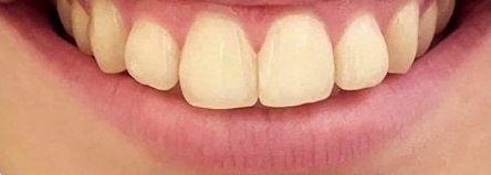Dents avant le blanchiment OnlySmile, cliente 2