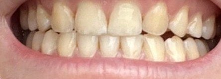 Dents avant le blanchiment OnlySmile, cliente 4